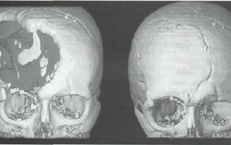 Сенсационное открытие ученых: сложнейшие операции проводили еще 2200 лет назад