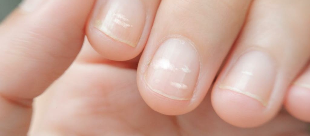 О каких проблемах со здоровьем свидетельствуют белые полоски на ногтях?