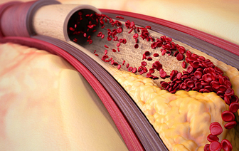 Как не допустить атеросклероз? Врачи назвали 3 лучших способа, как снизить холестерин