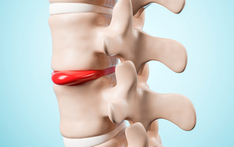 Корнем под дых: Обычный тёртый хрен оказался предвестником позвоночной грыжи