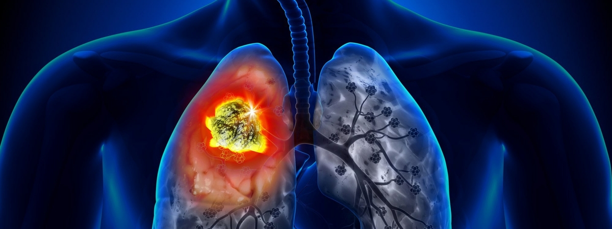 7 признаков того, что обычная простуда перетекла в пневмонию