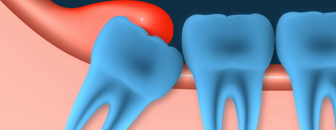 Как зубы мудрости могут навредить другим органам: правда и мифы