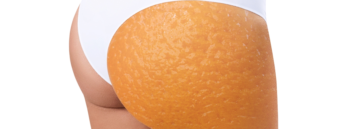 Ученые назвали 5 продуктов, провоцирующих целлюлит