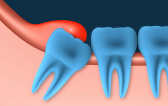 Как зубы мудрости могут навредить другим органам: правда и мифы