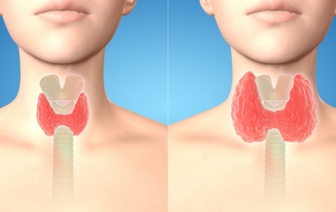 Зоб щитовидной железы: особенность организма или болезнь?
