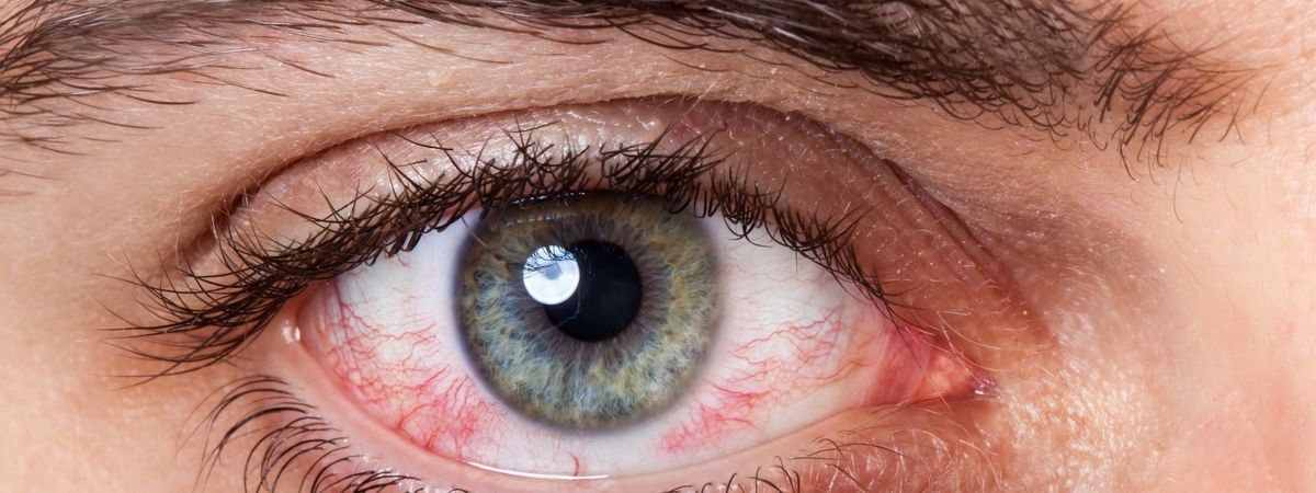 Медики рассказали, почему возникает покраснение глаз и как его лечить
