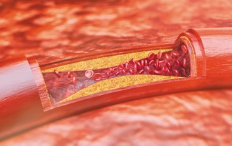 Немецкий ученый нашел истинную причину развития атеросклероза