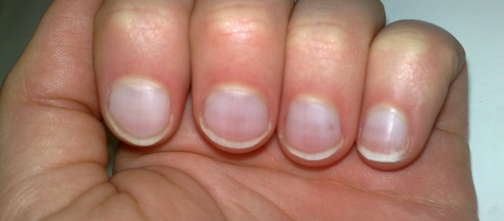 Гель-лак на ногтях мешает выявить и предотвратить серьёзные заболевания.