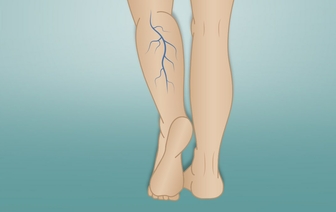 Варикоз = в ногах колхоз: Найдена новая причина расширения вен