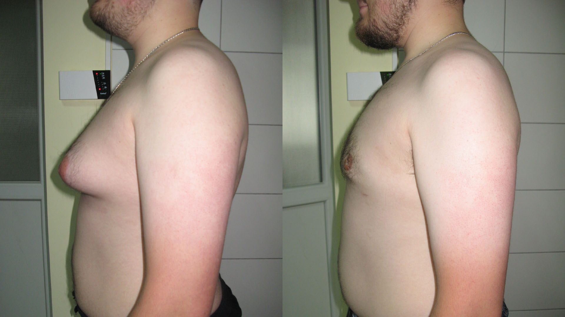 удаления жира из груди у мужчин фото 6